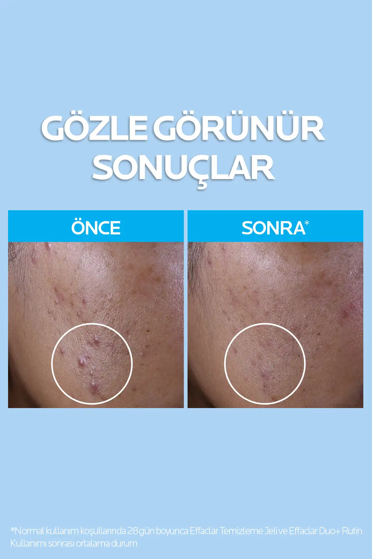 ست مراقبت از پوست های چرب و آکنه ای Effaclar St01409 برند   La Roche Posay(لاروش پوسای) به رنگ   در دسته ست مراقبت از پوست